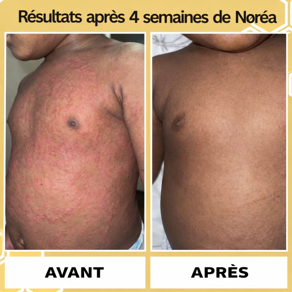 Crème Apaisante au Miel contre l'Eczéma