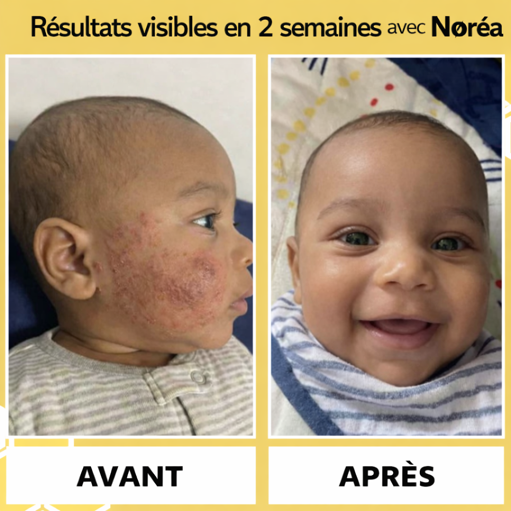 Crème Apaisante au Miel contre l'Eczéma